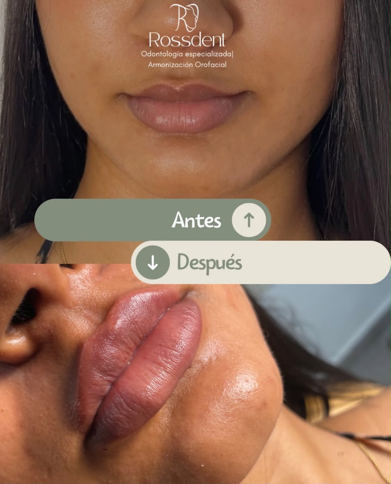 Caso real de armonización labial en Rossdent, antes y después