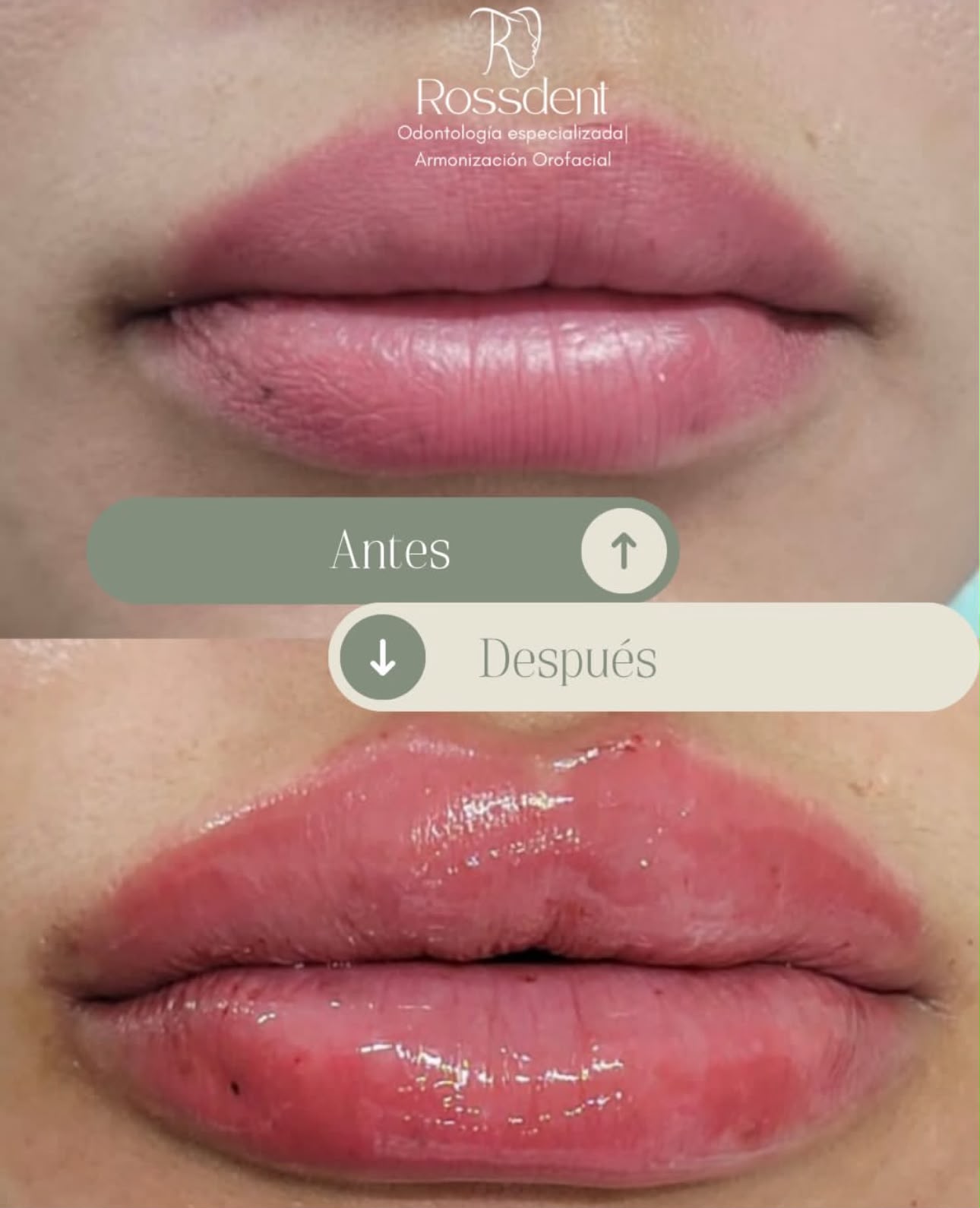 Segundo caso real de armonización labial en Rossdent, antes y después