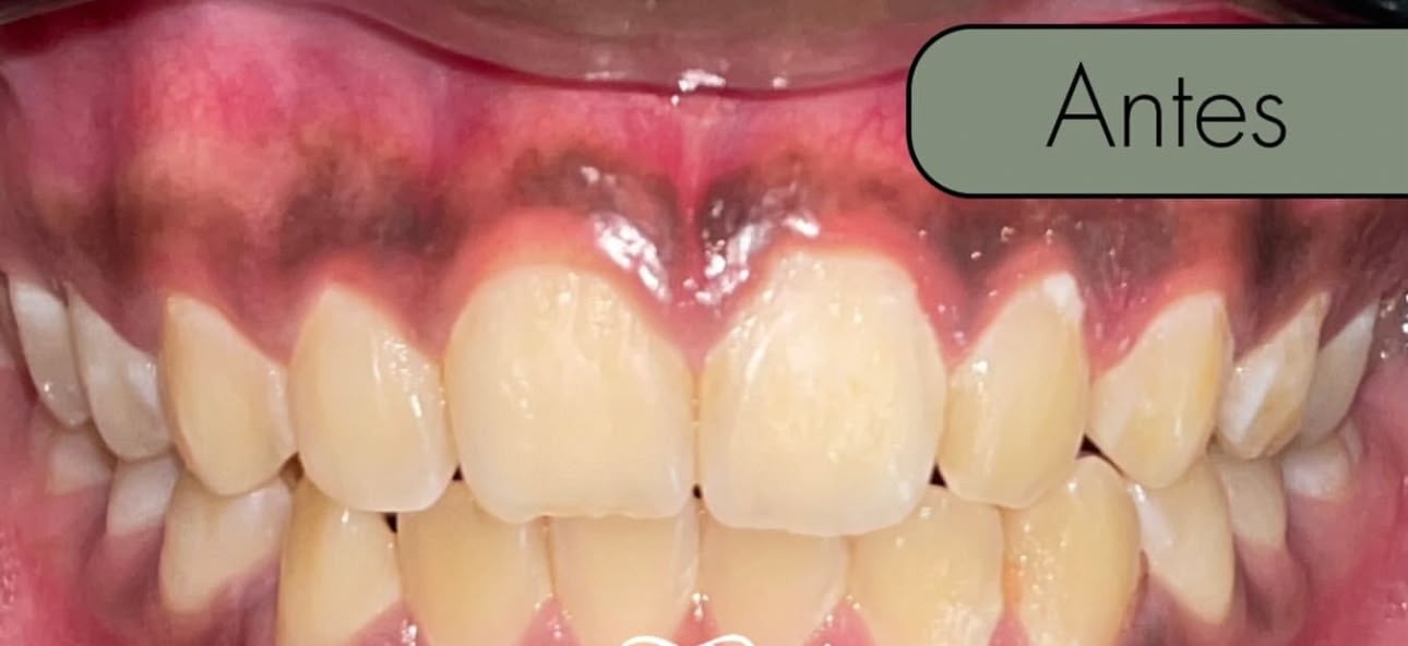 Antes del tratamiento de blanqueamiento y contorno gingival en Rossdent