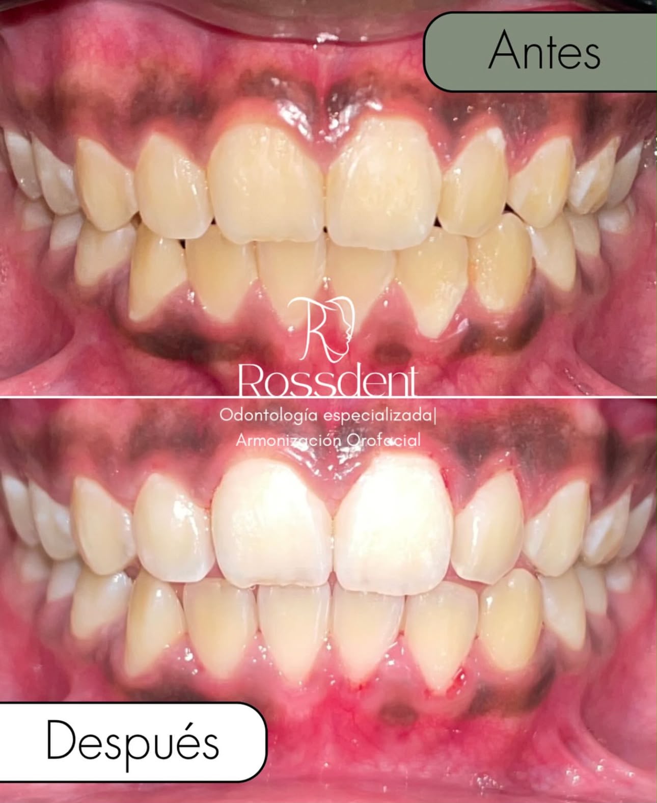 Caso real de blanqueamiento y contorno gingival en Rossdent, antes y después