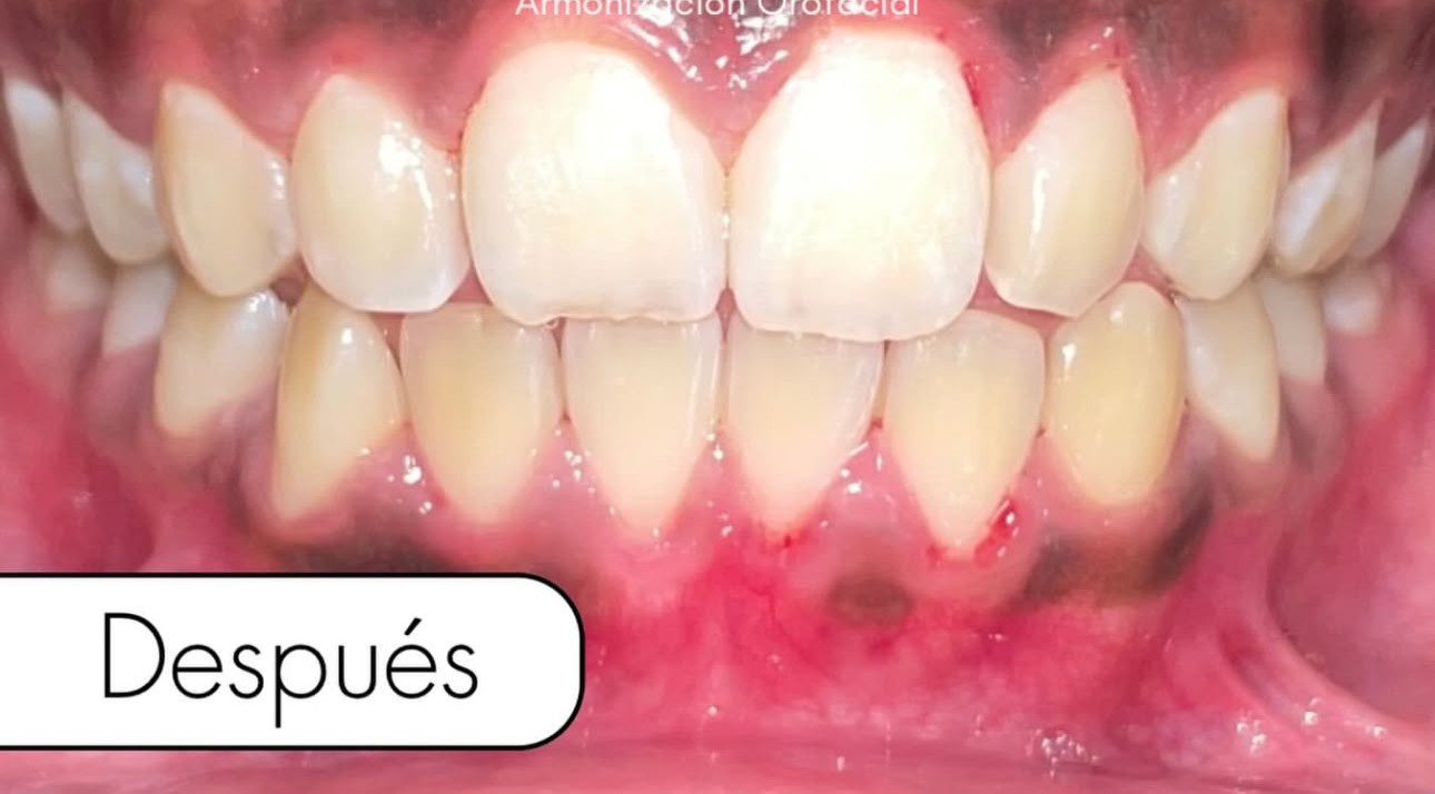 Después del tratamiento de blanqueamiento y contorno gingival en Rossdent