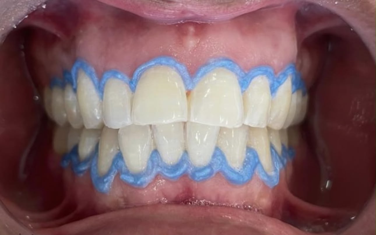 Procedimiento de blanqueamiento dental en curso en Rossdent