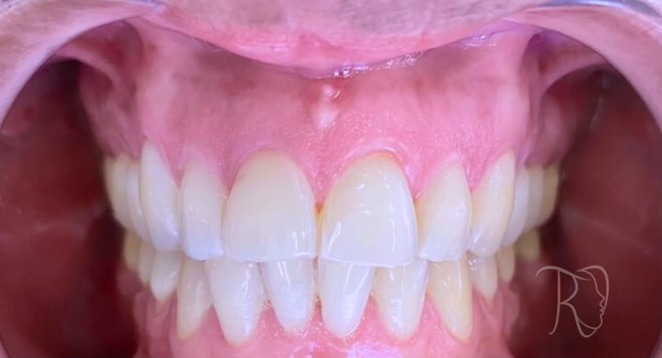Detalle de resultado de blanqueamiento dental en Rossdent